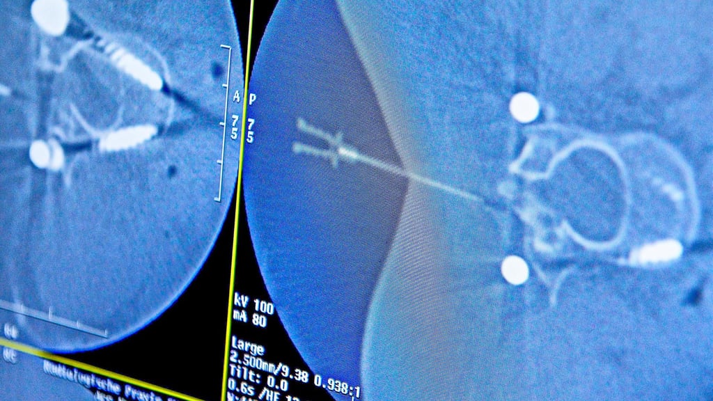 Bei einer&nbsp; rückenmarksnahen&nbsp;Regionalanästhesie wird das Medikament in den Spinalkanal verabreicht. Die Injektion wird am Computer verfolgt.