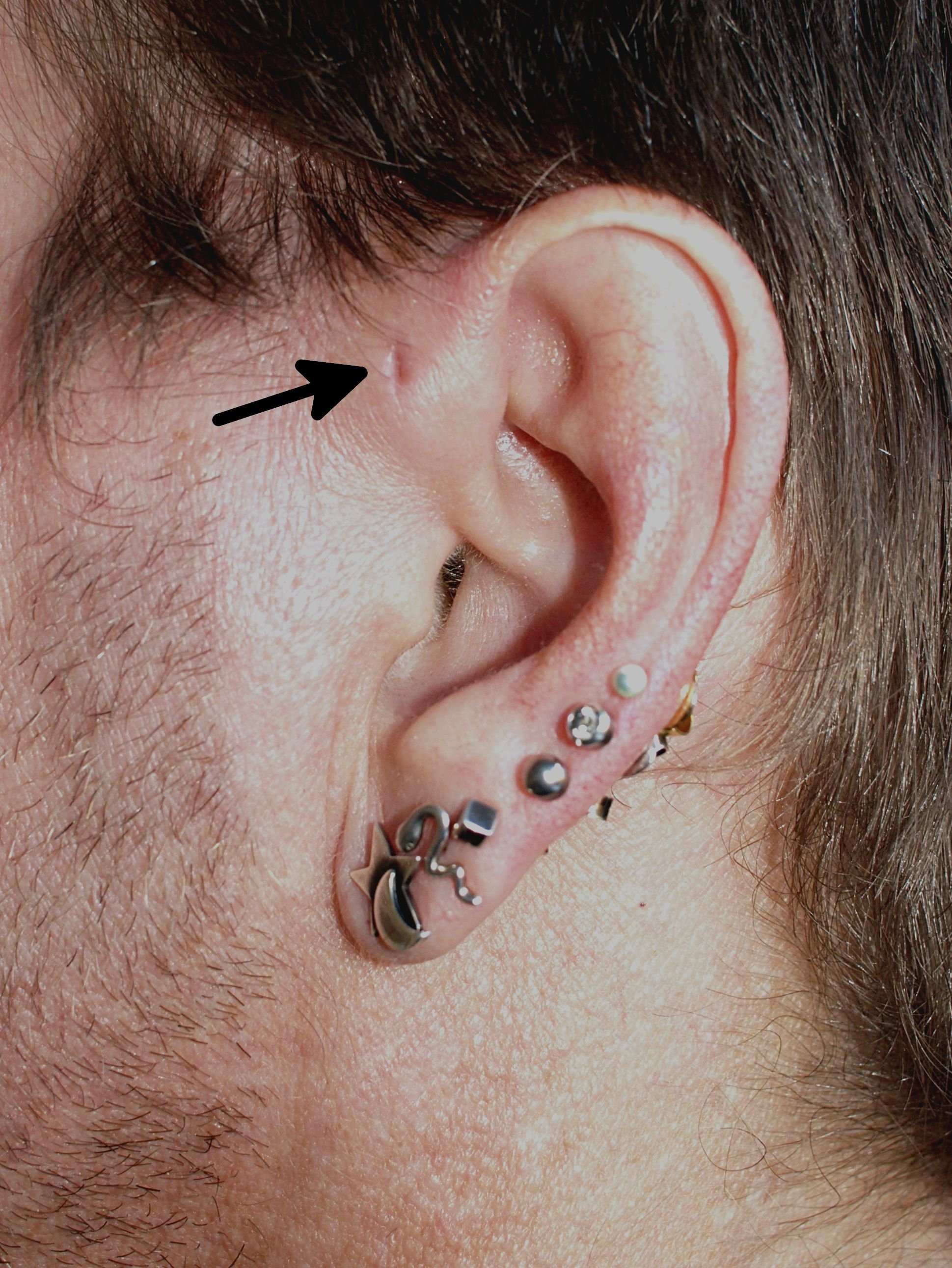 Das kleine Loch ist kein Überbleibsel vom ersten Piercing, sondern angeboren und extrem selten.
