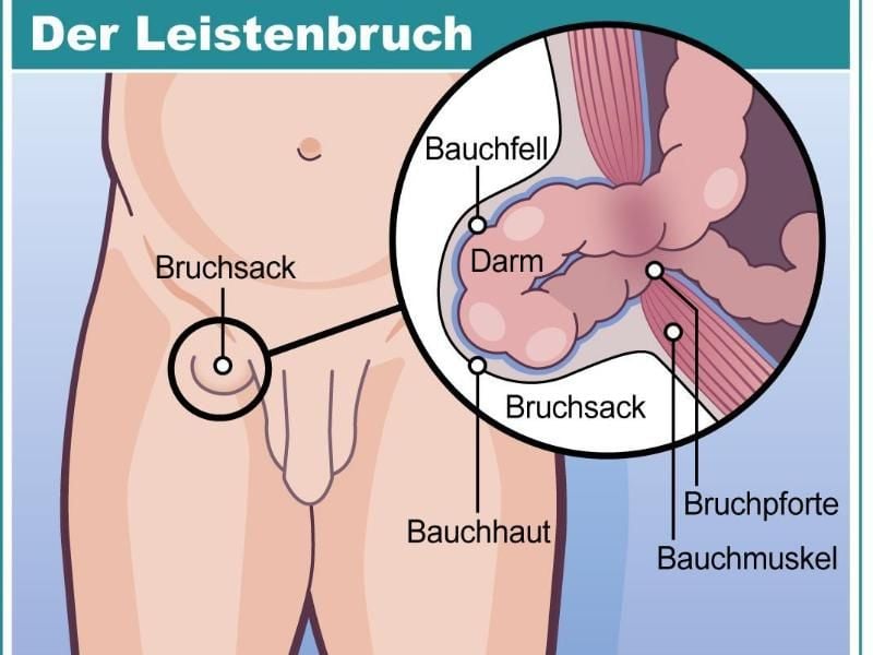 Bei einem Leistenbruch reißt die Bauchwand. Dabei können sich die Eingeweide nach außen stülpen. Foto: dpa-infografik