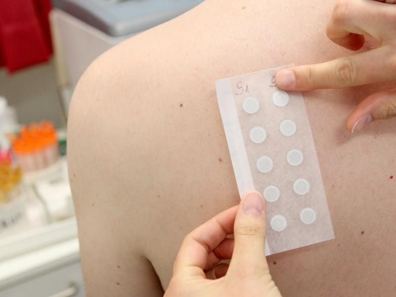 Zum Themendienst-Bericht vom 14. September 2020: Mit einem sogenannten Epikutantest versuchen Mediziner, Allergie-Auslösern auf die Spur zu kommen. Foto: Bodo Marks/dpa-tmn
