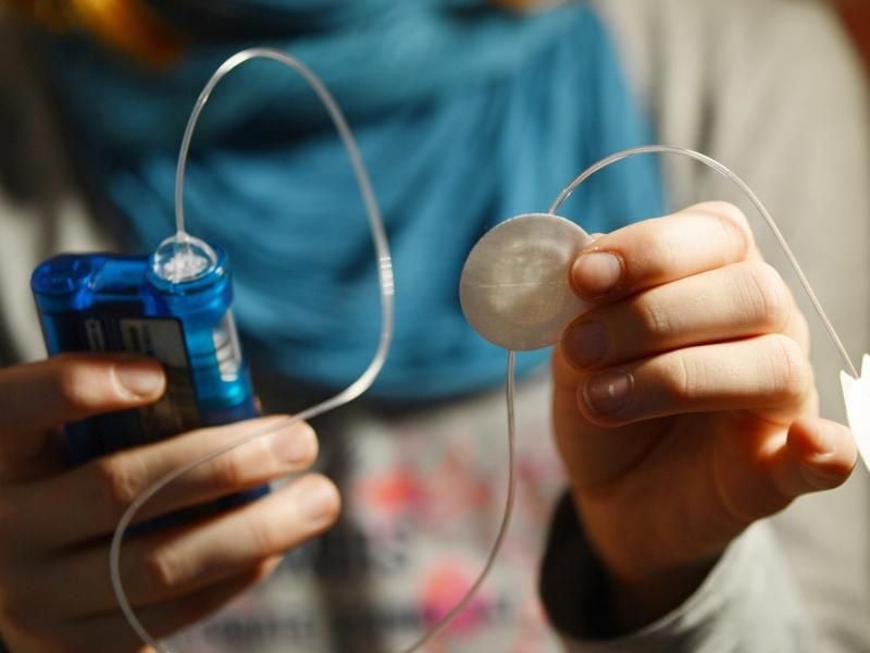 Ein an Diabetes Typ 1 erkranktes Mädchen pumpt Insulin durch den Katheter ihrer Insulinpumpe. Der Katheter wird in der Regel in Bauch, Oberschenkel oder Po gesetzt. Foto: Jens Kalaene/Symbolbild