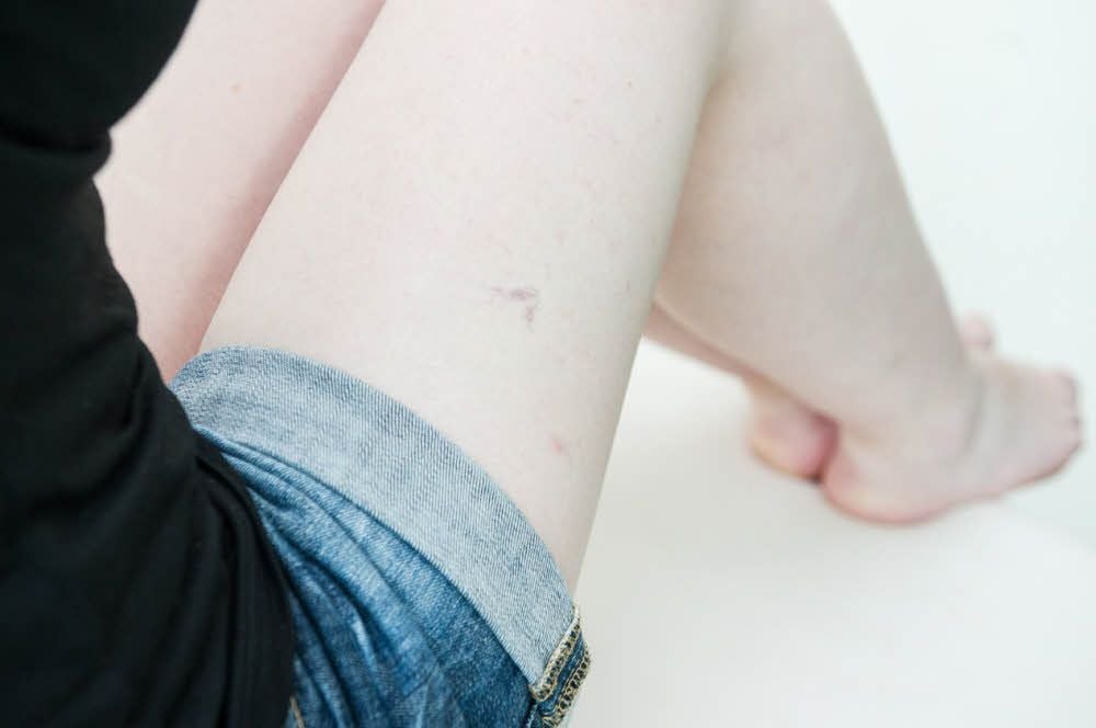 Gefäßbereiche, die von einer Venenschwäche betroffen sind, können mit dem neuen Laser minimal-invasiv behandelt werden.