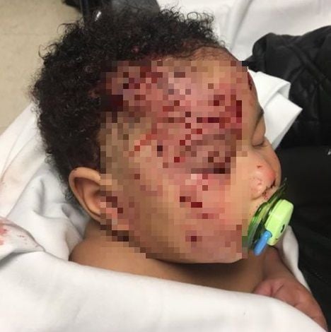 Die kleine Journi Black wurde schwer verletzt.