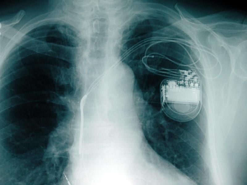 Ein Herzschrittmacher gibt dem Herz den Takt vor. Der Hersteller Medtronic muss nun bei einem seiner Modelle die Einstellungen ändern. Foto: Stefan Sauer/Illustration