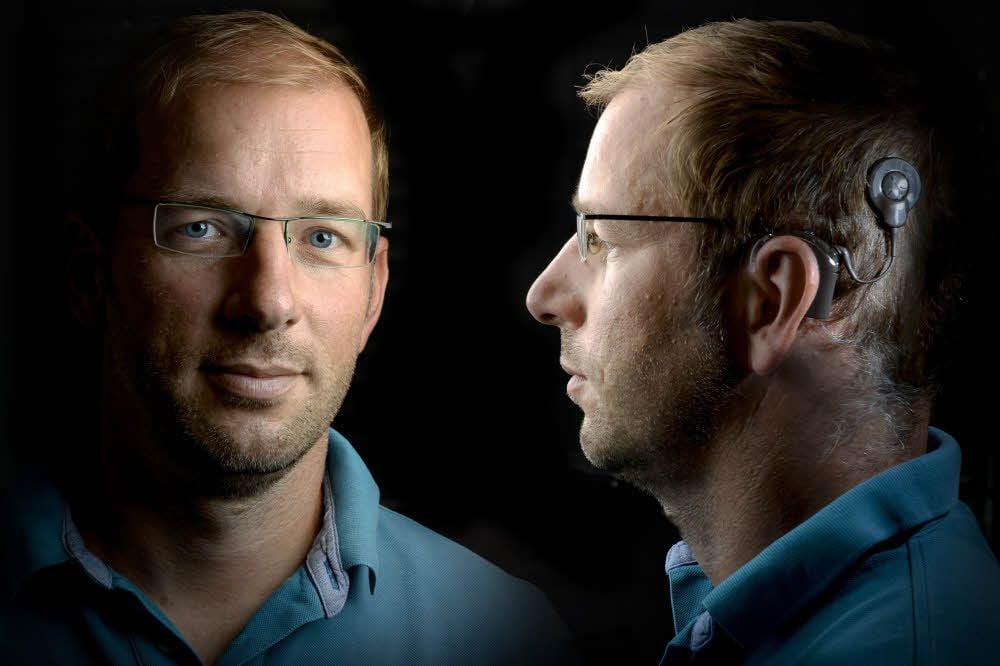Der Sprachprozessor und die Sendespule, die mittels Magnet am Kopf befestigt ist, bilden, so wie Michael Bastille es zeigt, den äußeren Teil der Hörprothese.