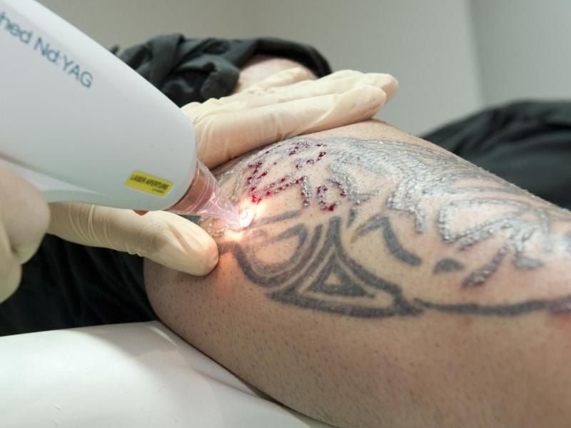 Eine Tattoo-Entfernung ist nicht unbedenklich - wer seine Tätowierung loswerden will, sollte die Laserbehandlung von Fachleuten durchführen lassen. Foto: Mascha Brichta/dpa-tmn