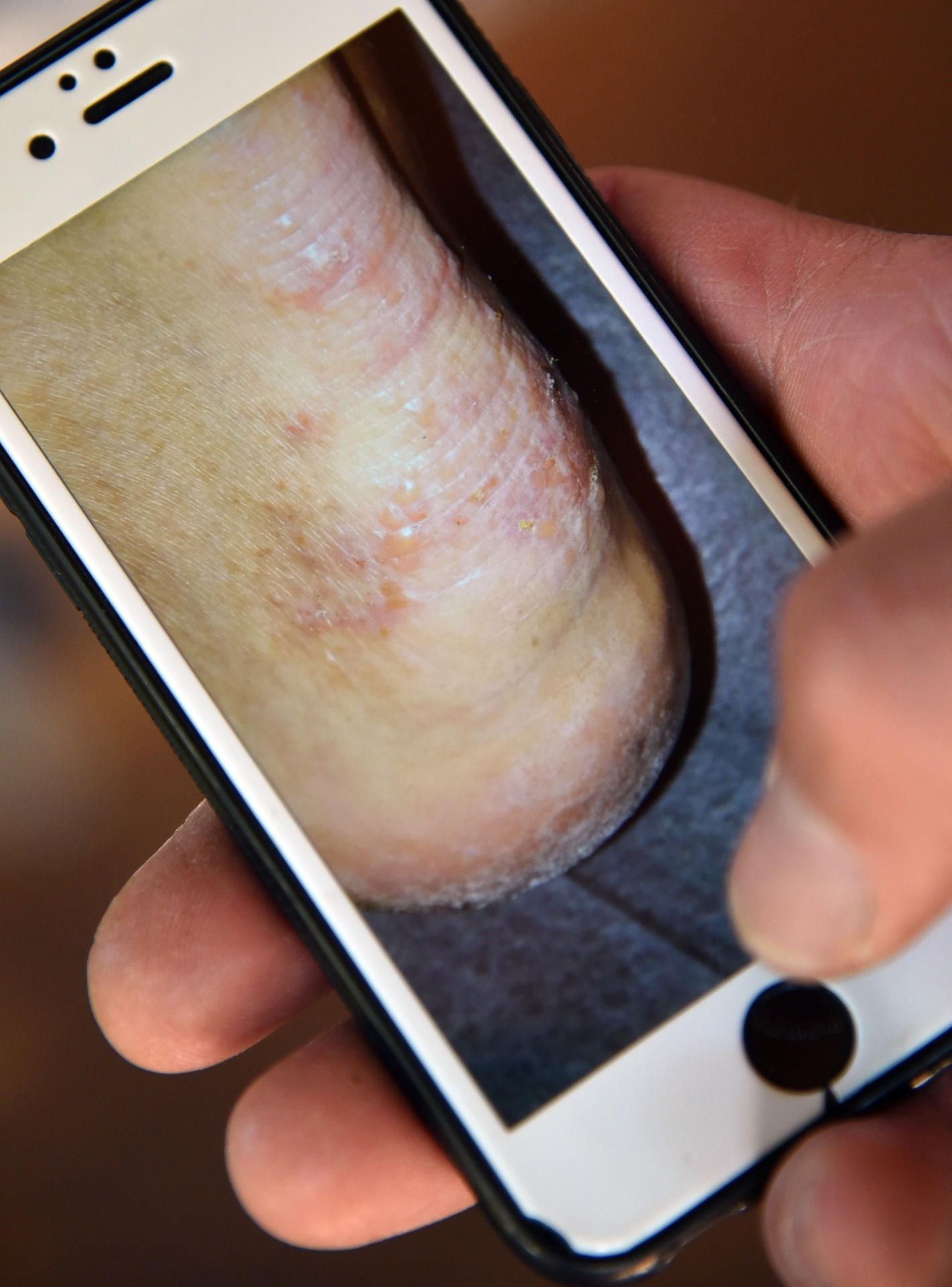 Ein Mann zeigt auf einem Smartphone ein Foto seines von Krätze befallenen Fusses. Die unter Fachleuten Skabies genannte Krankheit kann jeden treffen.