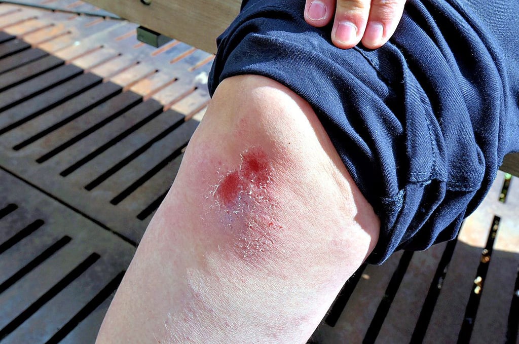Harter Aufprall - die Gestürzte holte sich ein blutiges Knie.