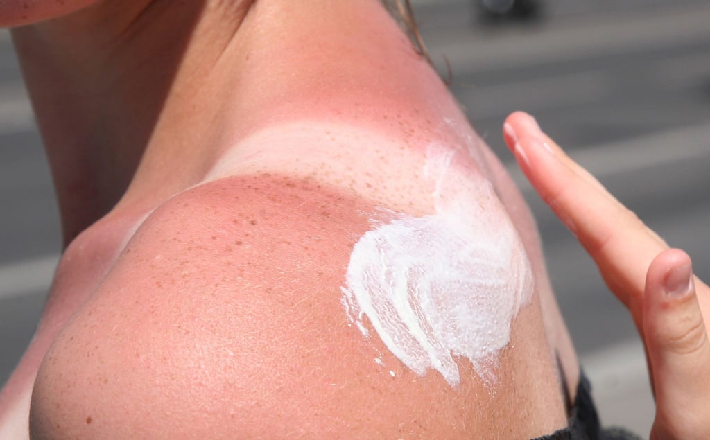 Hier kommt die Sonnencreme zu spät, die Haut ist schon verbrannt. Was hilft nun noch?