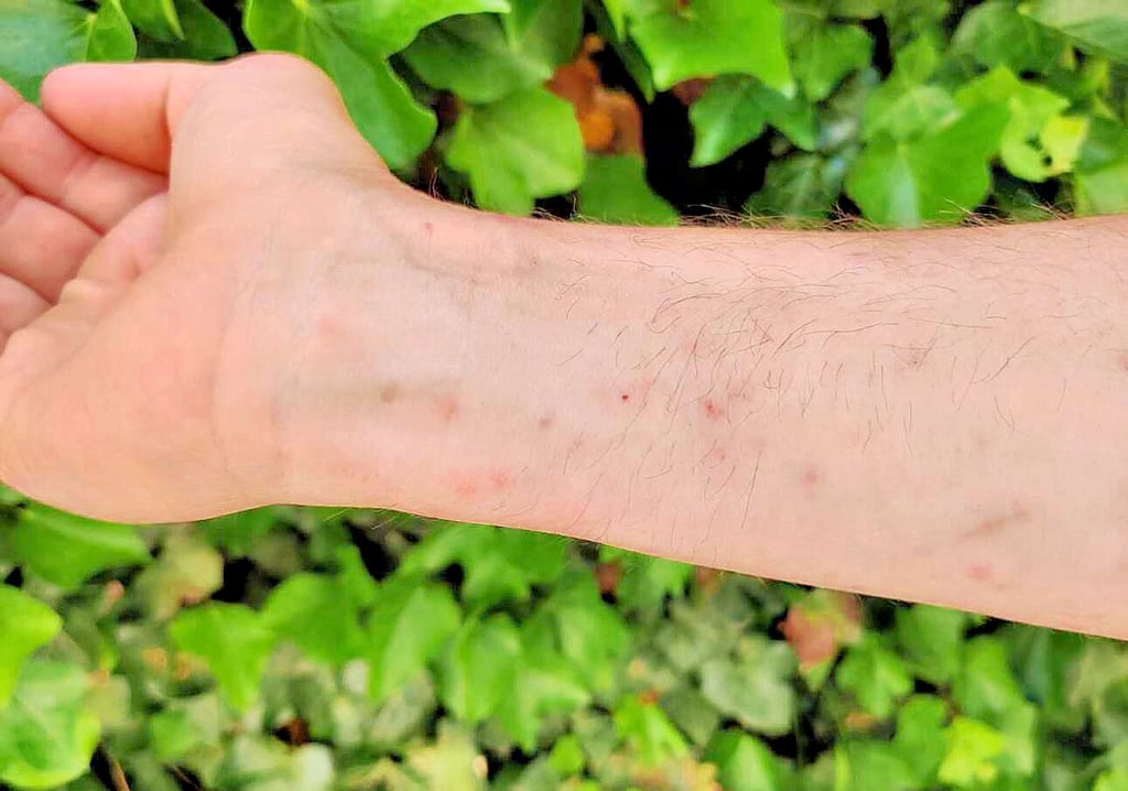 Zu Beginn des Ausschlags sind nur einige kleine Rötungen zu sehen, später ist die Haut mit deutlich mehr roten Pusteln übersäht.