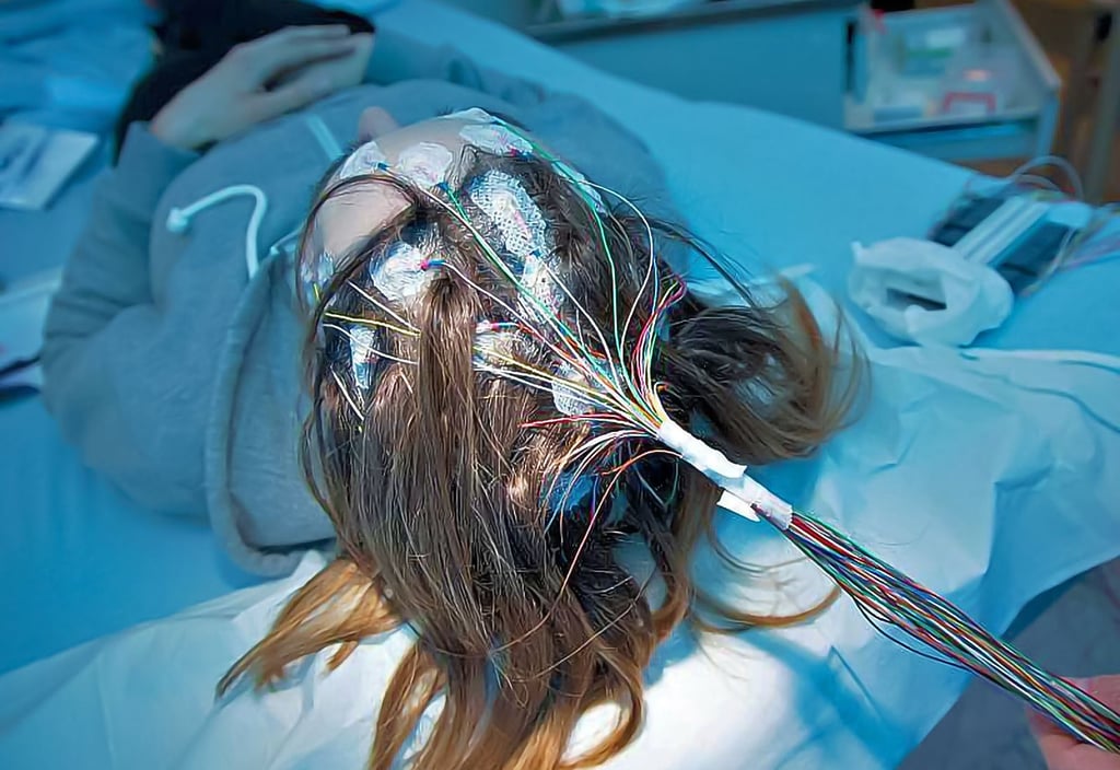 Mit Elektroden können bei Epilepsie-Patienten Gehirnströme gemessen werden.