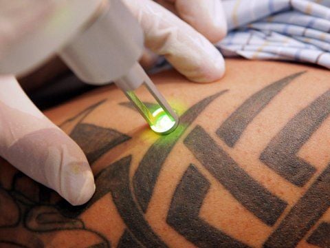 Viele Tattoos lassen sich auch wieder entfernen. Doch das ist ein schmerzhafter und langwieriger Prozess.