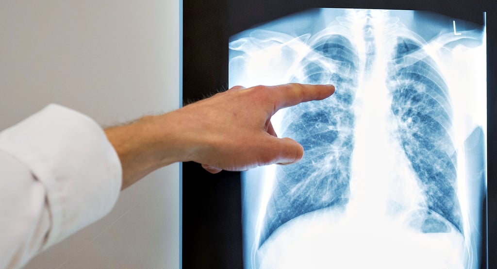 Zu sehen ist das Röntgenbild einer Lunge. Wer in Schönebeck eine Überweisung zum Röntgen beim Radiologen bekommt, wird eine solche Fachpraxis in Schönebeck allerdings nicht finden. In Staßfurt aber beispielsweise.