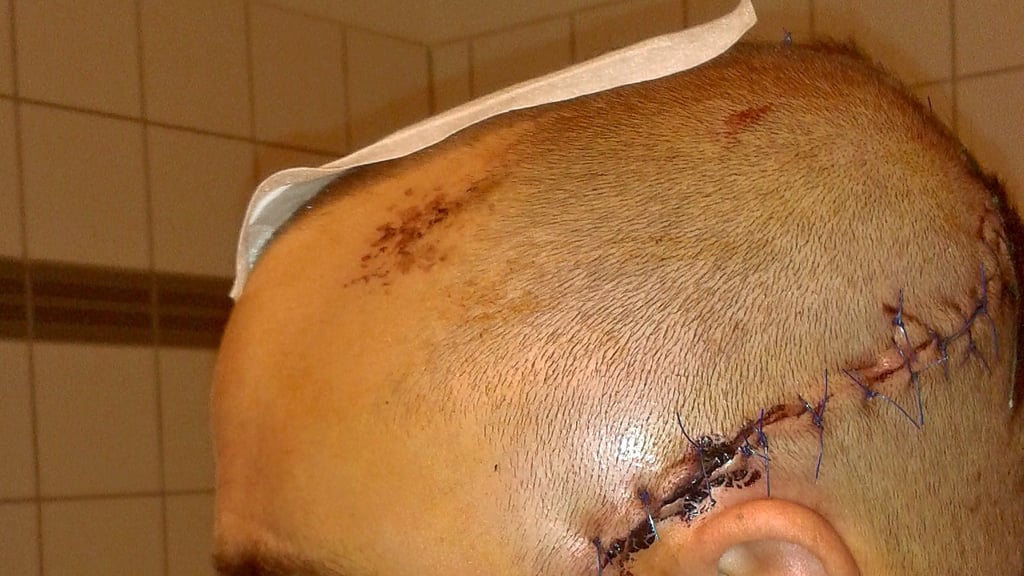 Wenige Tage nach dem Unfall hat Michael Bierau im Krankenhaus dieses Foto von seinen Schädelverletzungen aufgenommen.
