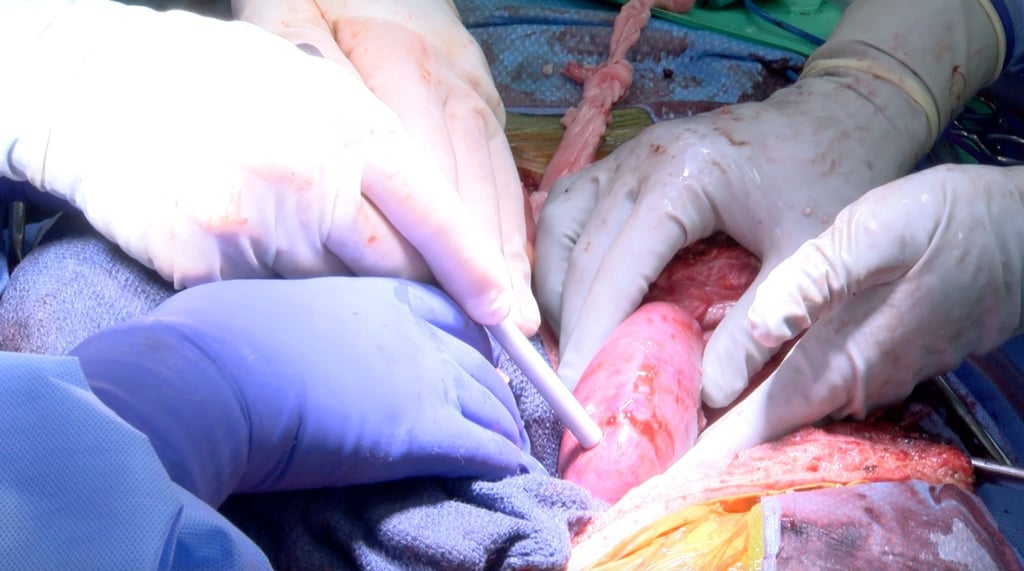 Gut zwei Wochen nach der Transplantation eines Schweineherzens berichten US-Mediziner von der Übertragung von Schweinenieren auf einen Menschen.