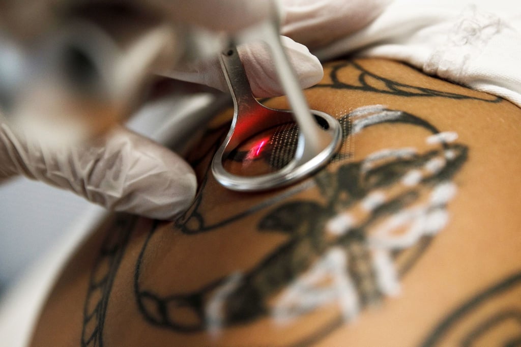 Wird ein Tattoo per Laser entfernt, muss die Behandlung in der Regel mehrmals wiederholt werden.