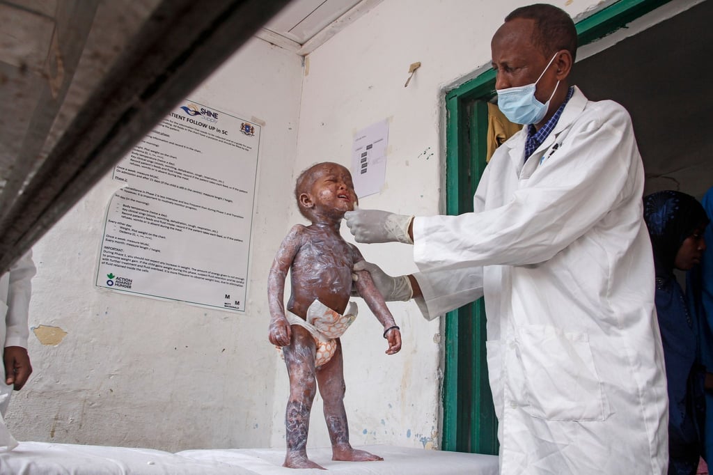 Ein Arzt in Mogadischu trägt Hautcreme auf ein Kind auf, das Symptome von Kwashiorkor zeigt, einer schweren Eiweißunterernährung, die Schwellungen und Hautläsionen verursacht.