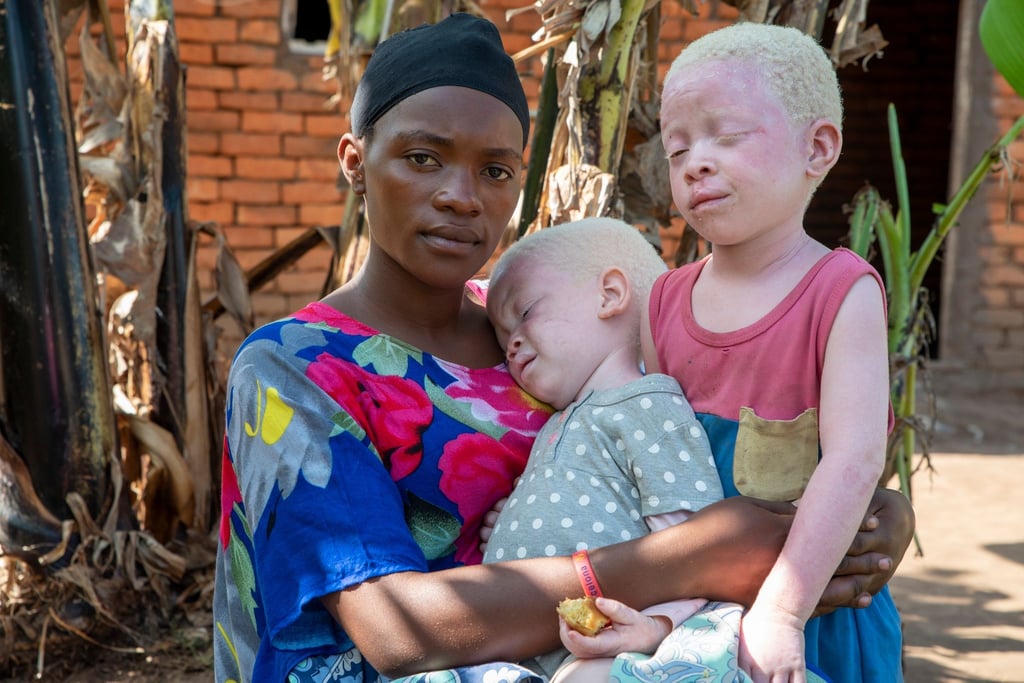 Faith (l, 22) ist die Mutter von Akram (2,5, M) und Aisha (4). Sie hat zwei Kinder mit Albinismus.