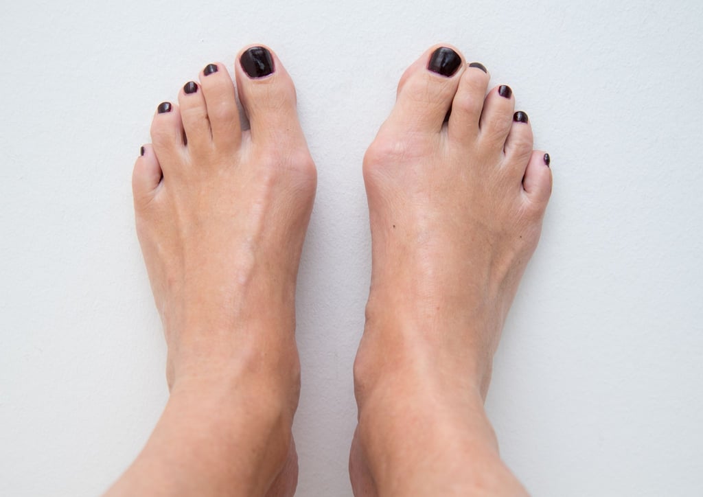 Wer einen Ballenzeh Hallux valgus hat, erkennt das unter anderem am Köpfchen des Mittelfußknochens. Es tritt bei der Fehlstellung oft stark an der Fußinnenseite vor.