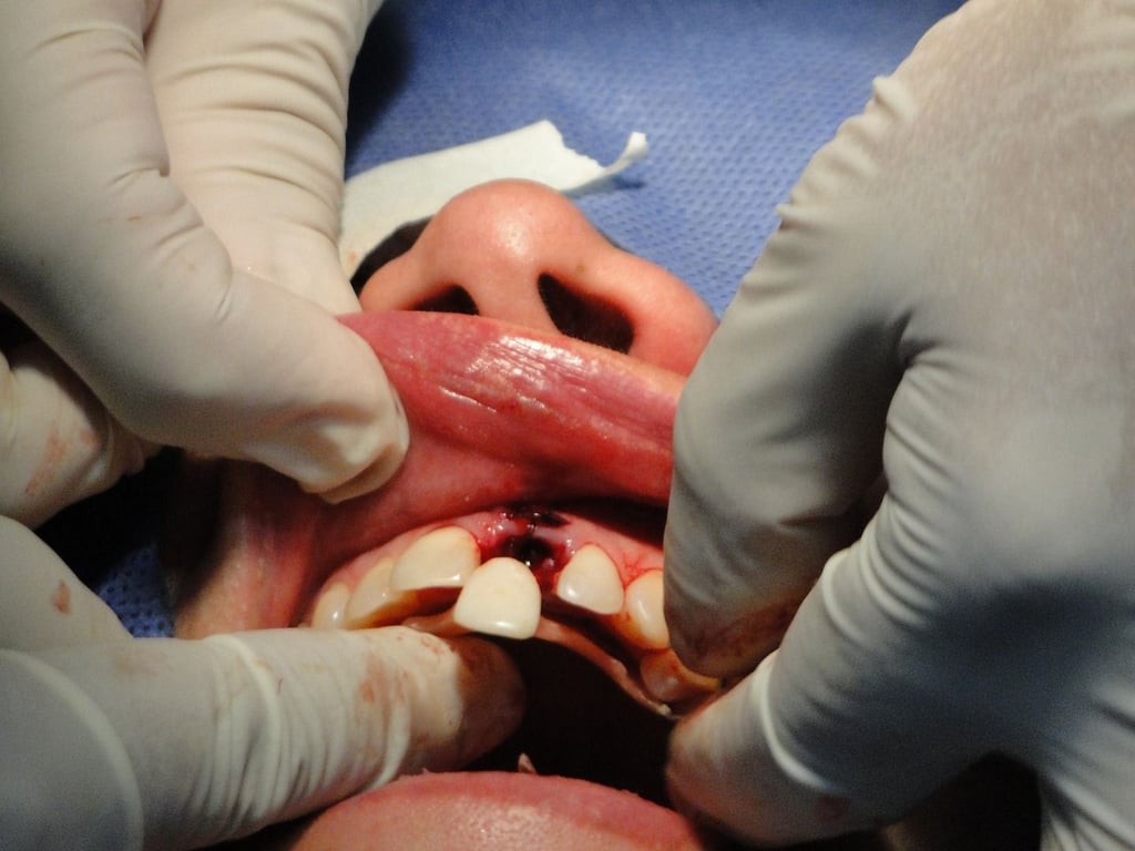 Ein Implantat wird direkt mit dem Kieferknochen verbenden.  Der Patient auf dem Bild erhält ein Frontzahn-Implantat.  These are often cheaper than back teeth.