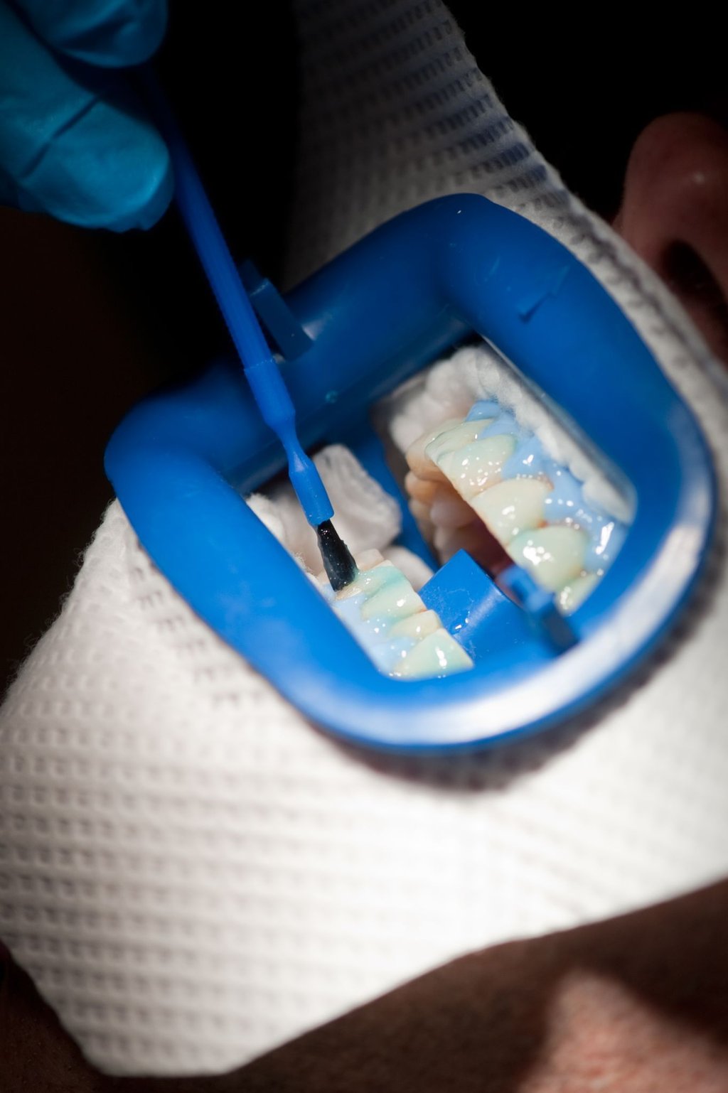 Auf die Zähne kommt beim Bleaching ein Bleichmittel - das blaue Gel schützt dabei das Zahnfleisch.