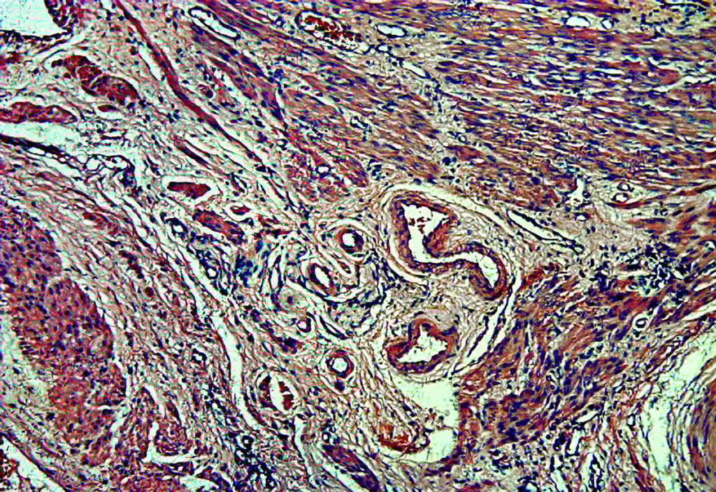 Histologischer Schnitt durch das Gewebe einer Gebärmutter mit einem Myom.