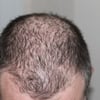 Vor allem Männer leiden mit zunehmendem Alter und einem kahler werdenden Haarschopf