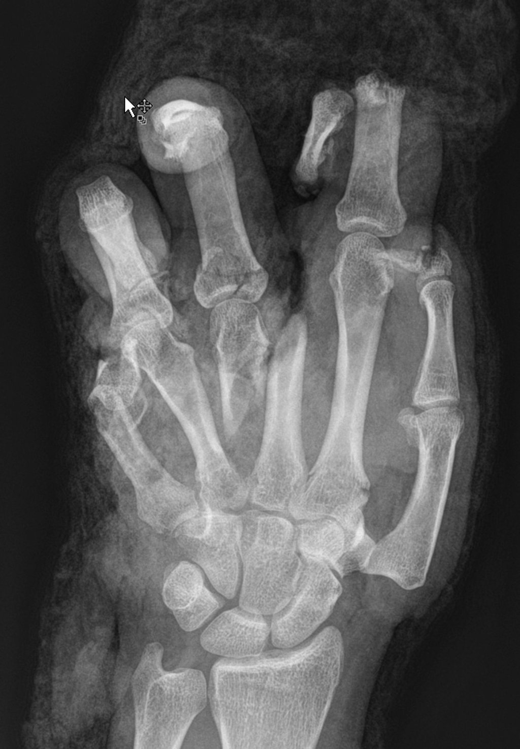Bilanz einer Silvesternacht: Vor allem Verletzungen an der Hand hat das BG Klinikum Bergmannstrost behandelt. Fast 30 Patienten kamen mit Verletzungen rund um Feuwerke, acht mussten operiert werden.