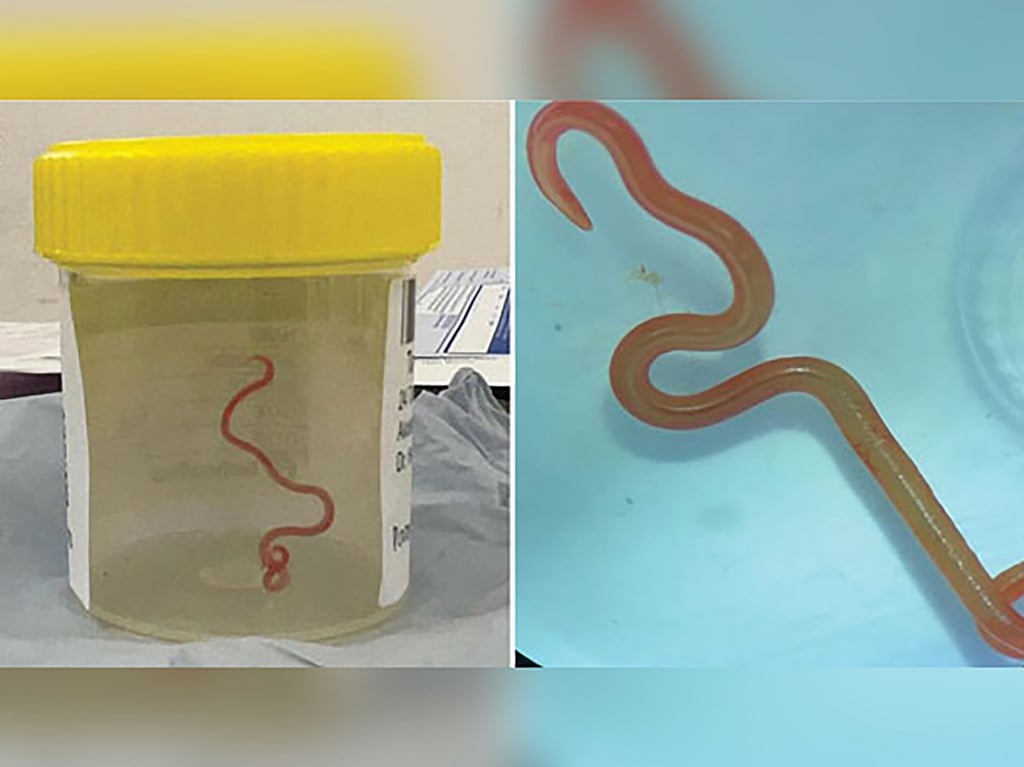 Der lebende Spulwurm „Ophidascaris robertsi“ wurde im Gehirn einer 64-jährigen Australierin gefunden.