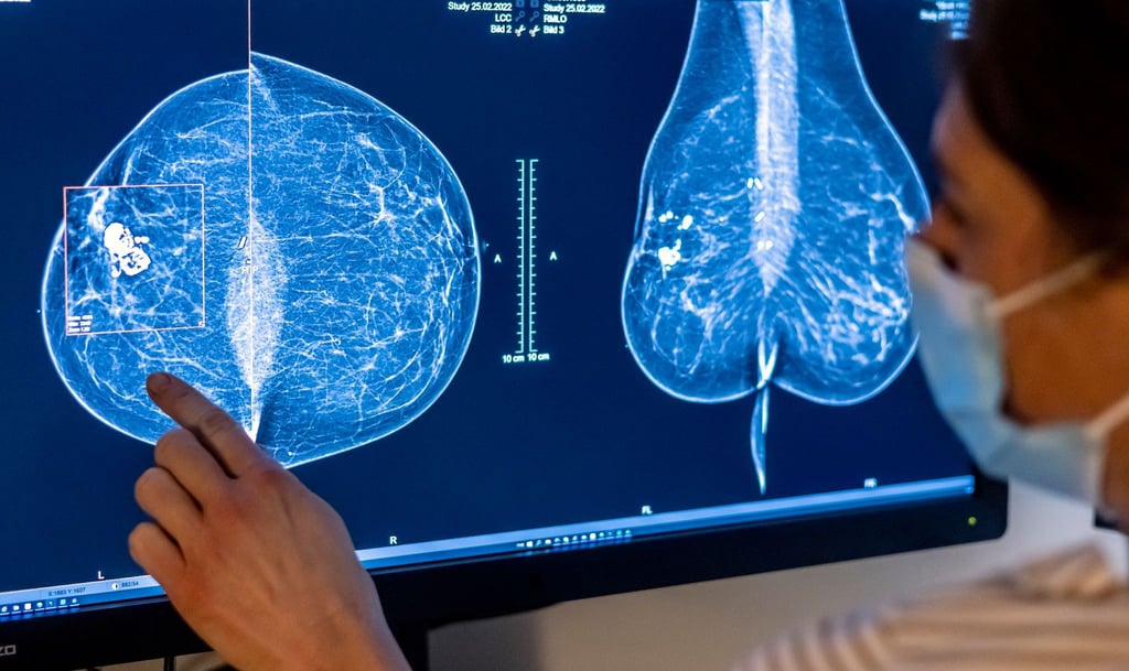 Mammografie in einer Klinik in Berlin. Frauen sind nicht nur von Brustkrebs betroffen, sondern häufig auch von Gebärmutter-, Lungen- und Darmkrebs.