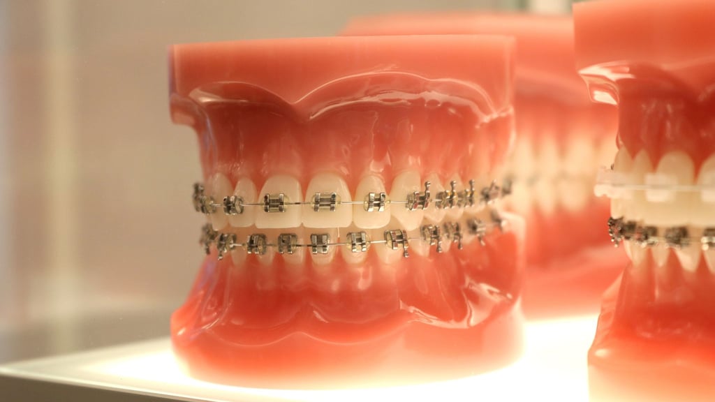 Braucht ein Kind eine Zahnspange, sind manche Extras bei der Kieferorthopädie-Behandlung sinnvoll.