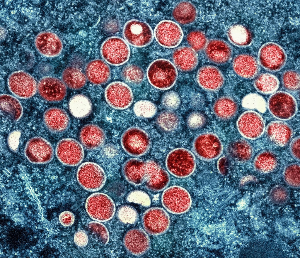 Forschende haben Gen-Veränderungen des Mpox-Erregers näher untersucht.