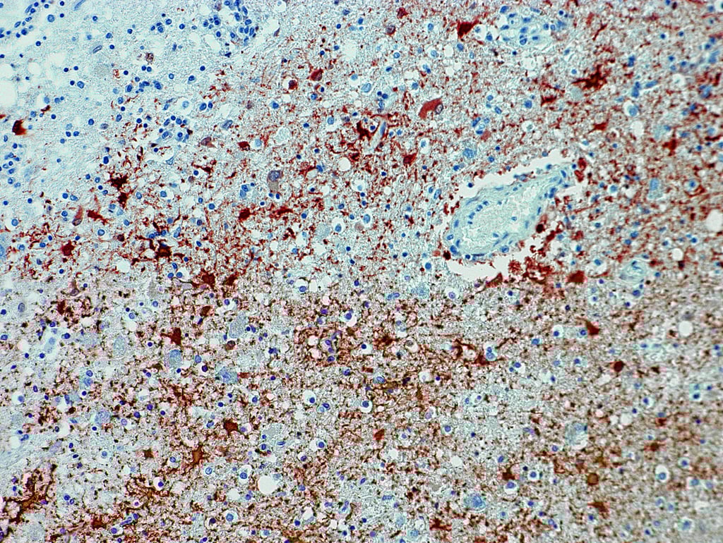 Die undatierte Aufnahme zeigt einen Anitkörpernachweis zum Borna-Virus im Gewebe.