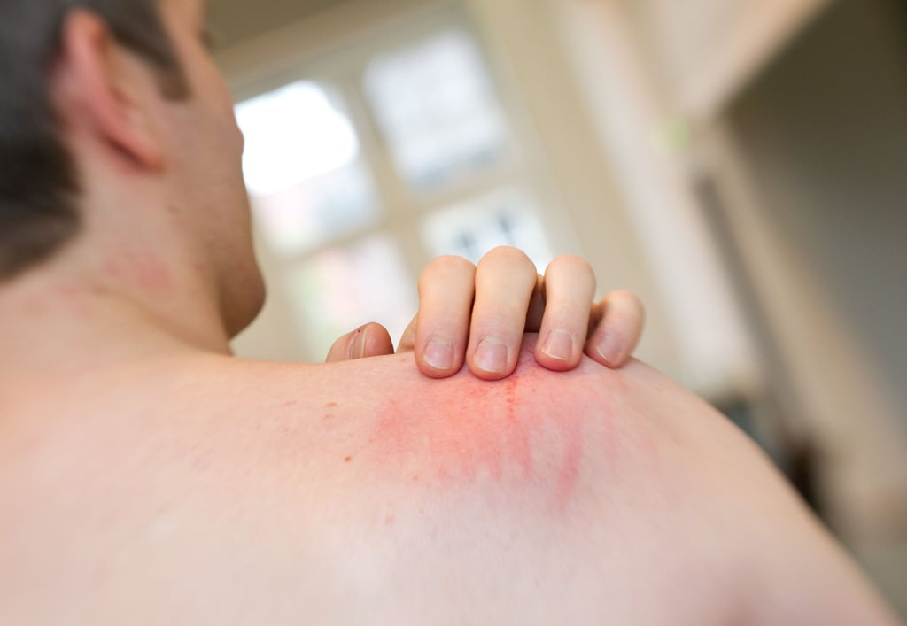 Ein Juckreiz-Patient mit geröteter Hautstelle an der Schulter.