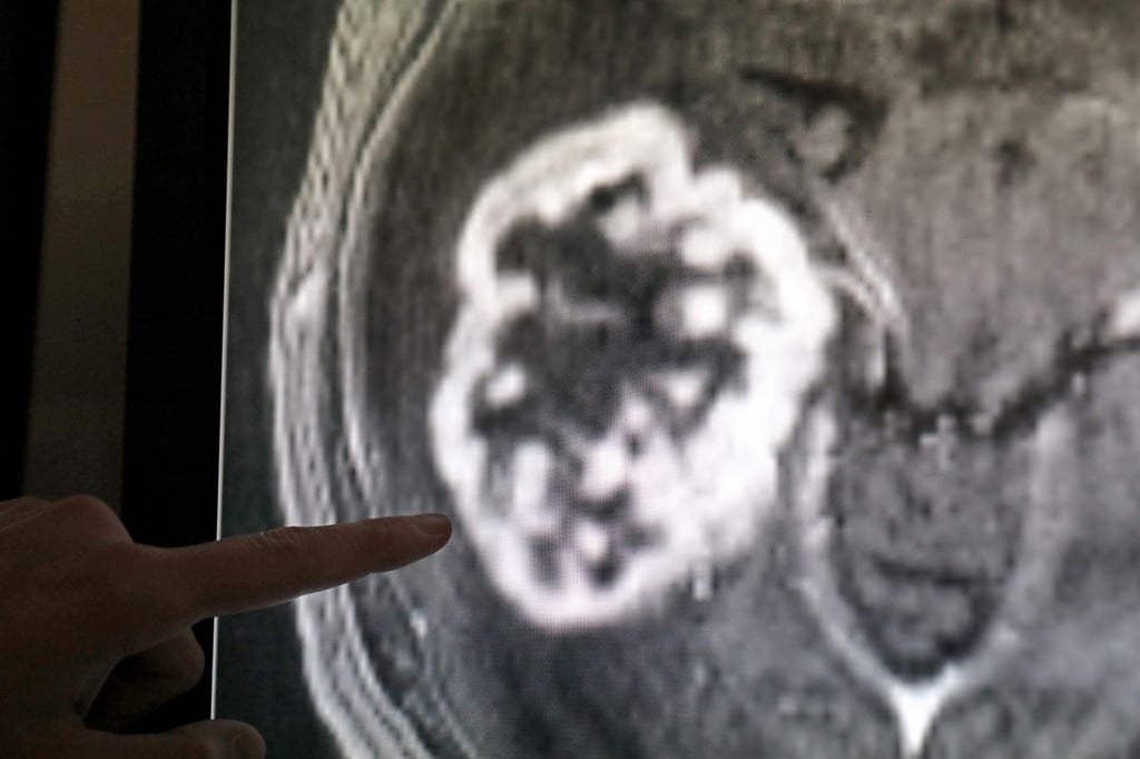 In der Diagnostik der Radiologie der Universitätsmedizin wird mithilfe der Magnetresonanztomografie ein Tumor festgestellt.