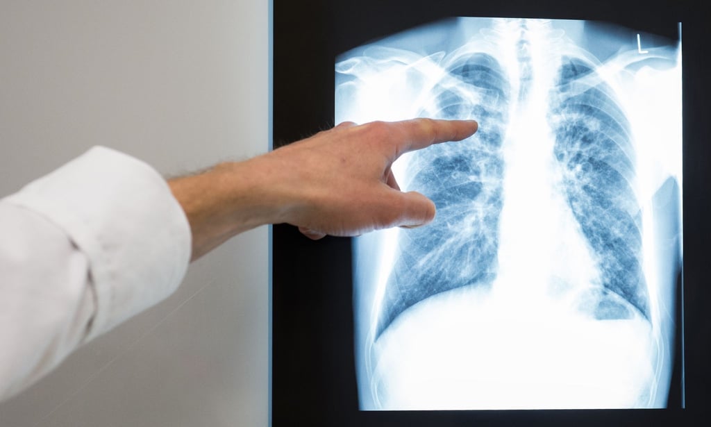Die Weltgemeinschaft ist nicht auf Kurs, ihre selbstgesteckten Ziele zur Eindämmung der Tuberkulose zu erreichen.
