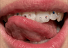 Bunte Steinchen auf den Zähnen zu haben ist besonders unter jungen Frauen gerade total angesagt. Ein Magdeburger Zahnarzt erklärt die Gefahren. 