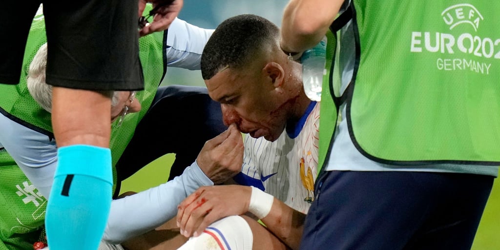 Frankreichs Kylian Mbappe wird behandelt, nachdem er sich bei einem Zusammenstoß an der Nase verletzt hat.