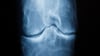 Spätestens das Röntgenbild schafft Klarheit: Der Knorpel nutzt sich immer mehr ab. Im späteren Stadium einer Arthrose reibt Knochen direkt auf Knochen.