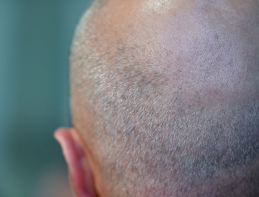 Mittel gegen Haarverlust gelten als sogenannte Lifestyle-Medikamente.