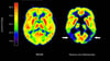 Haben die Amyloid-Plaques schon irreversible Schäden im Gehirn angerichtet, nützt ihre Entfernung nichts mehr. (Archivbild)