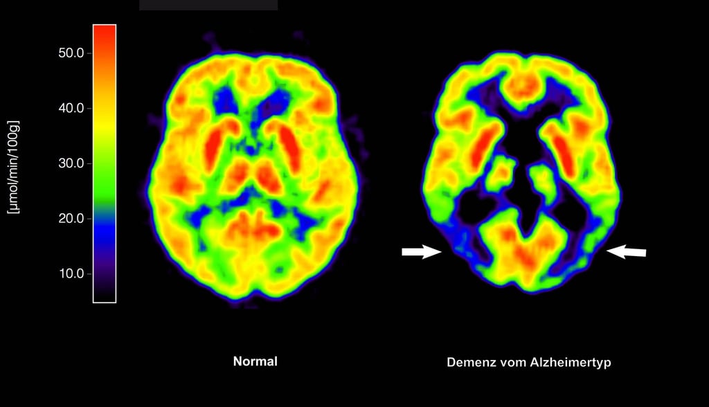 Entscheidung über die Zulassung für Medikament zur Behandlung von Alzheimer-Patienten verzögert sich. (Archivbild)