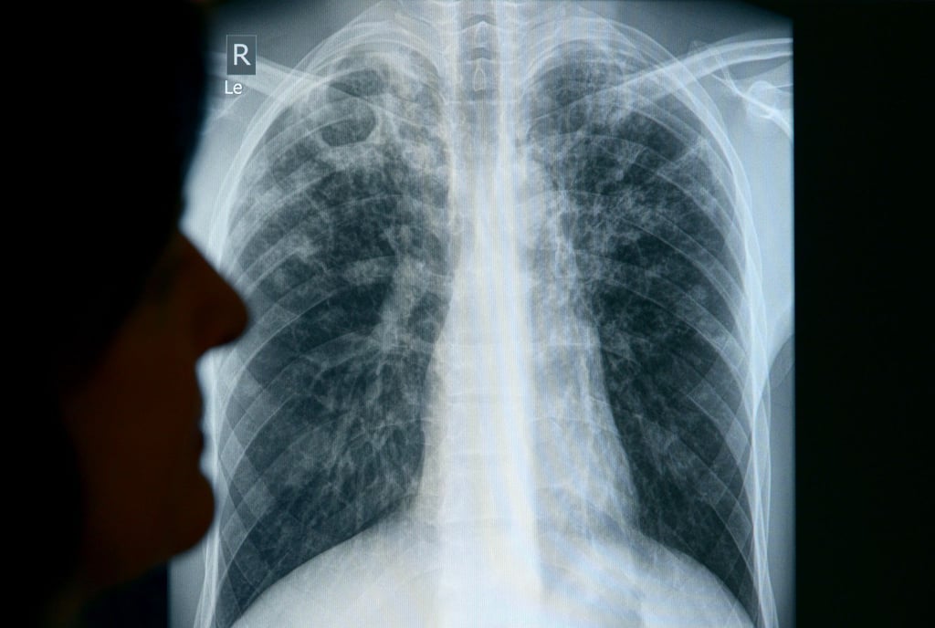 Im vergangenen Jahr wurden in Sachsen-Anhalt insgesamt 94 Tuberkulose-Fälle gemeldet. (Symbolbild)