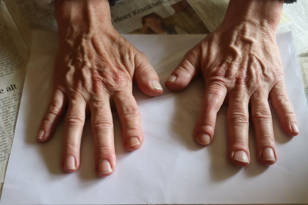 Das sind die Hände von Dorit Reuter aus Röwitz. Sie hat TRPS. Charakteristisch bei ihr sind die kurzen Daumen und krummen Finger. Foto: Markus Schulze