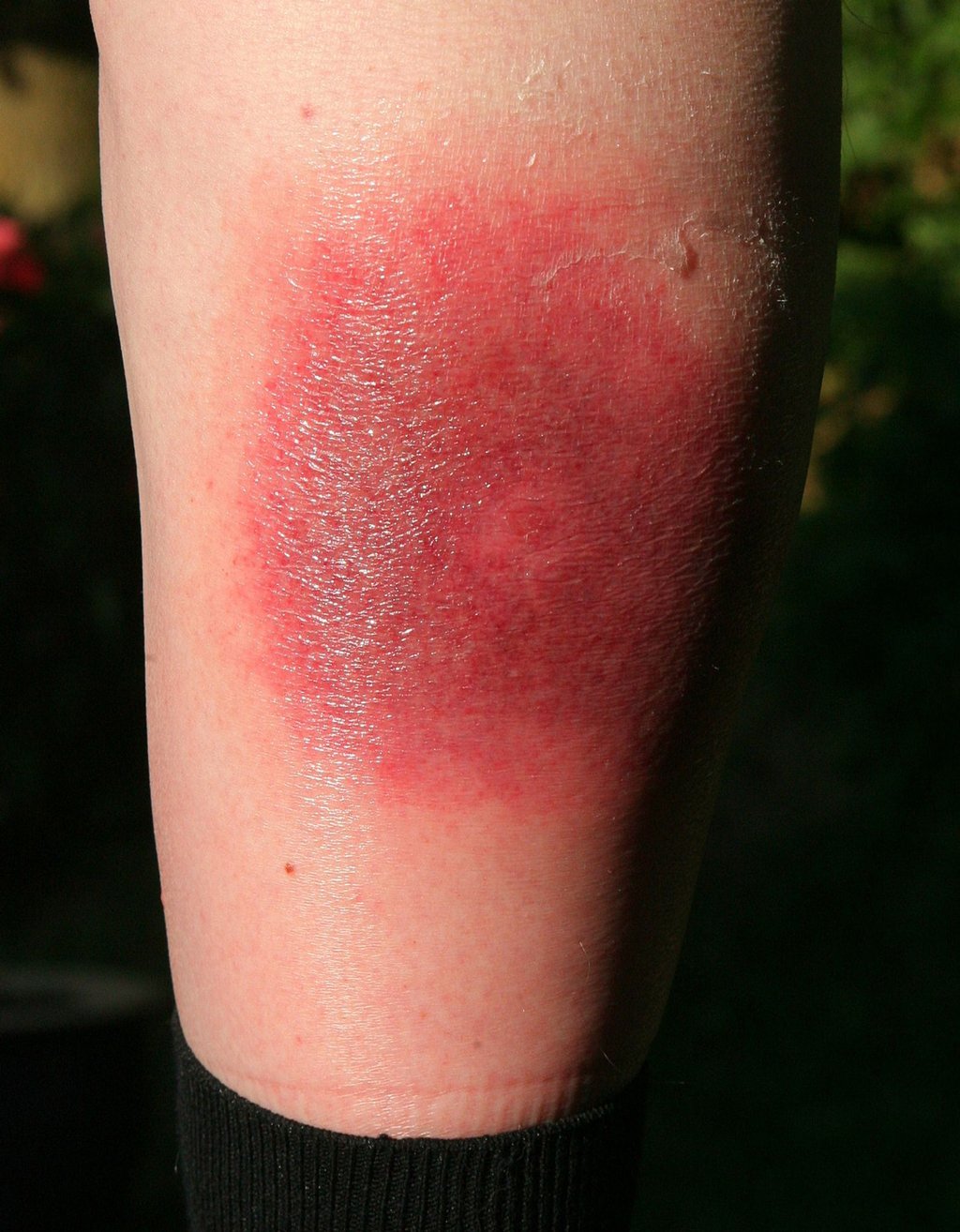 Klares Warnzeichen für Borreliose: Die sogenannte Wanderröte kann Tage oder Wochen nach einem Zeckenstich auftreten.