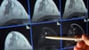 Im Zuge des Mammographie-Screening-Programms können Frauen alle zwei Jahre eine Röntgen-Untersuchung der Brust zur Früherkennung in Anspruch nehmen. (Archivbild)