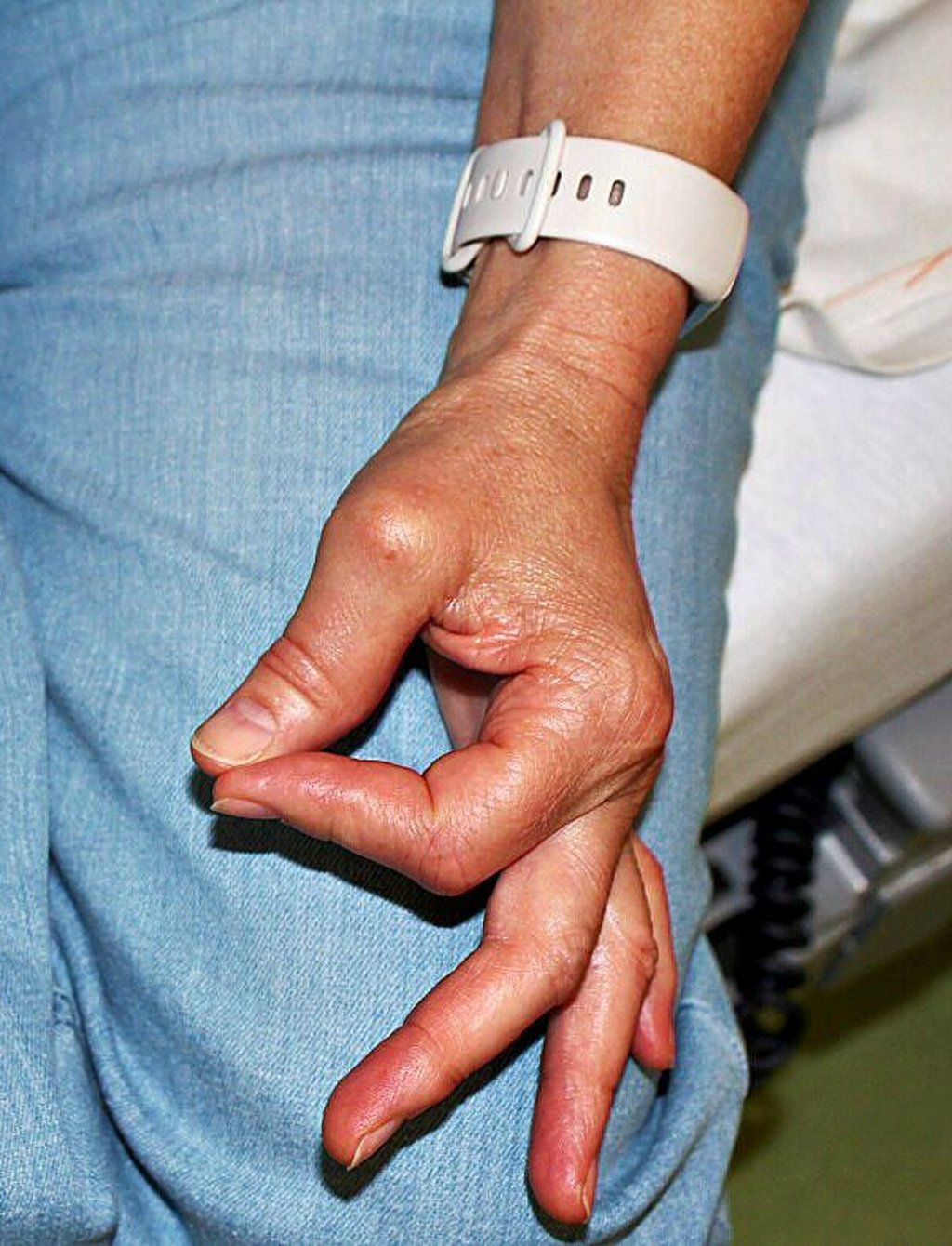 Typisches Zeichen der Erkrankung: Patienten können kein O-Zeichen formen.