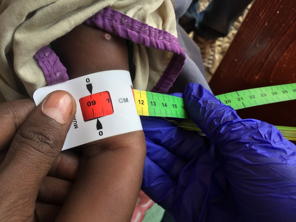 Der Armumfang eines schwer unterernährten Babys in Somalia wird gemessen. (Archivbild)