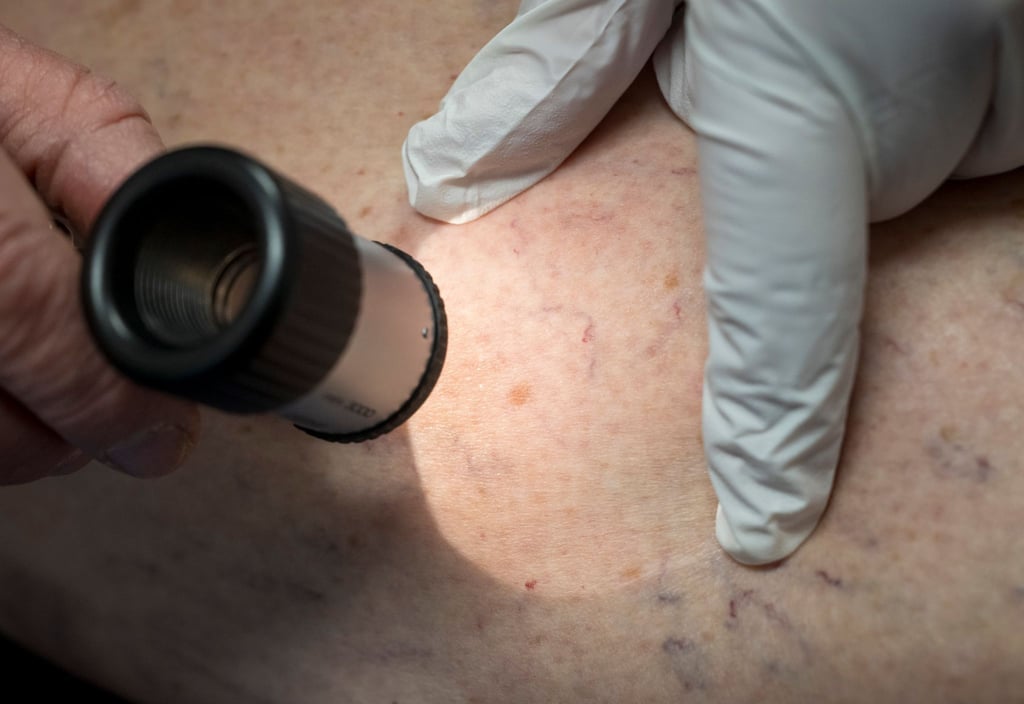 Hautkrebsfälle steigen nach Krankenkassen-Zahlen in Niedersachsen deutlich an. (Symbolbild)