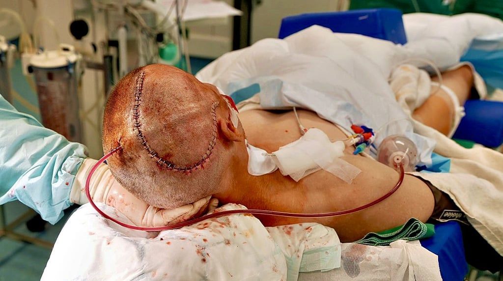 Erstmals ist es Ärzten am Dessauer Klinikum gelungen, eine 3D-gedruckte, bioresorbierbare Schädeldachplastik bei einem Patienten zu implantieren. Der Patient nach dem Eingirff mit verschlossener Kopfhaut.